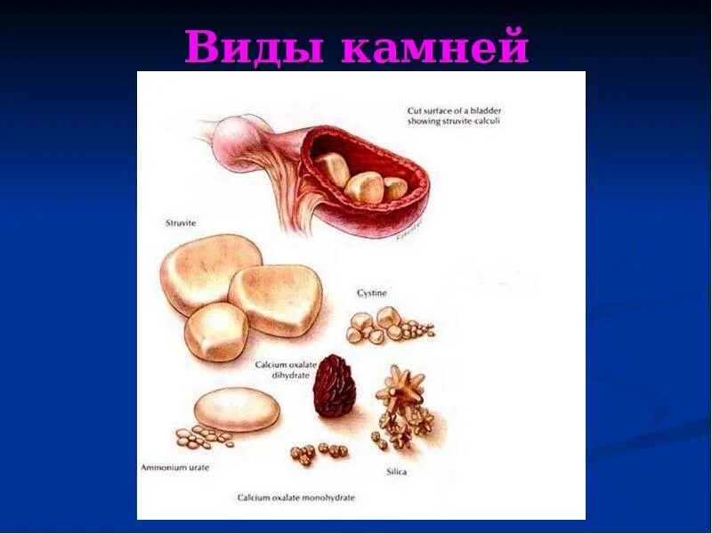 Мочекаменная болезнь классификация. Мочекаменная болезнь камни. Классификация мочекаменной болезни. Классификация камней при мочекаменной болезни. Разновидности камней в почках.