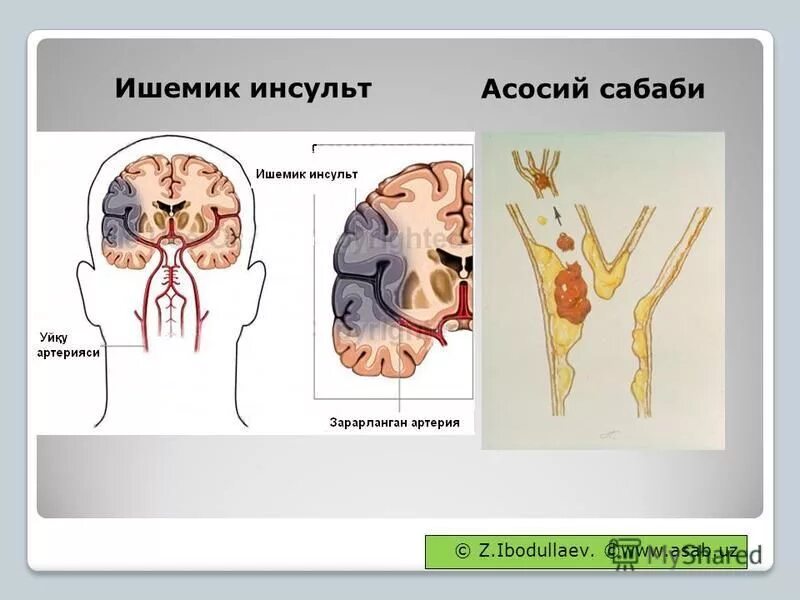 Панфилова инсульт. Презентация на тему инсульт. Картинки на тему инсульт. Презентация на казахском на тему инсульт.
