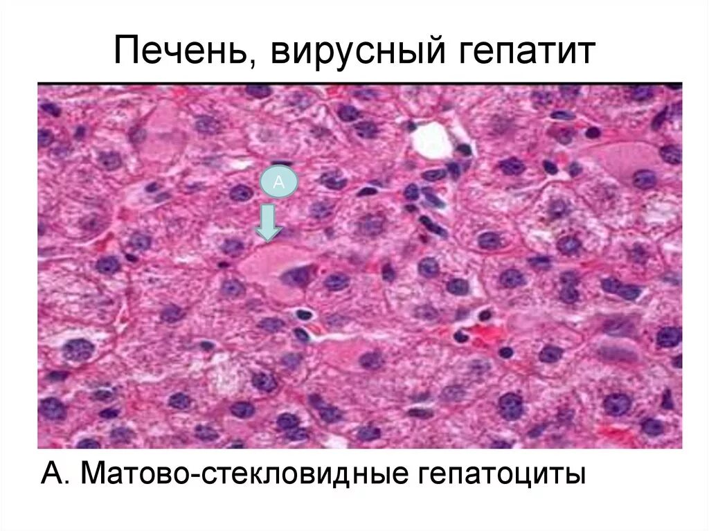 Гепатоциты гистология. Гепатит печени патанатомия. Вирусный гепатит гистология. Матовостекловидные гепатоциты.