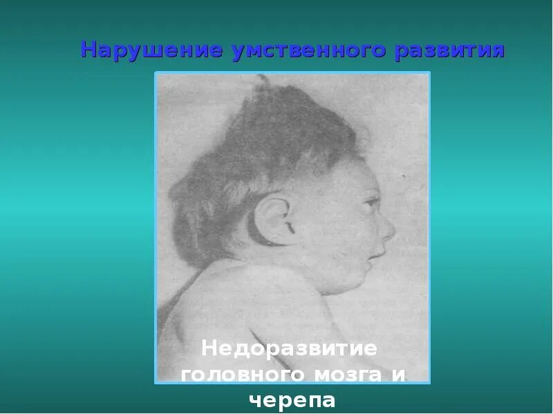 Недоразвитие и поврежденное развитие. Недоразвитие головного мозга. Нарушение умственного развития. Патология умственного развития.