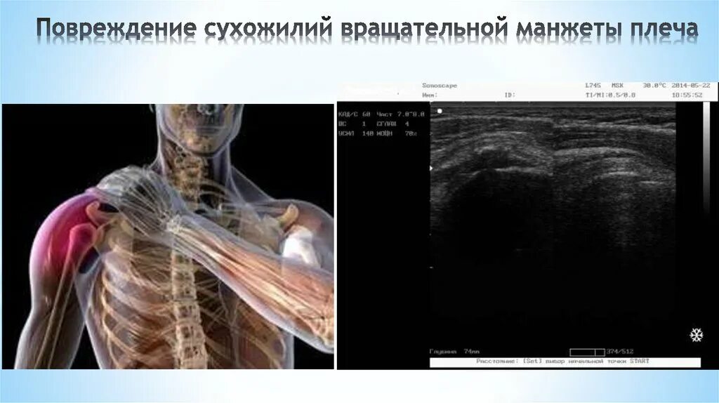 Повреждение вращательной манжеты мкб. Разрыв надостной мышцы манжета. разрыв сухожилий вращательной манжеты плеча. повреждение вращающей манжеты плеча. разрыв вращающей манжеты плеча.