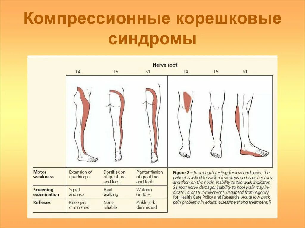 Радикулопатия с6. Компрессионные синдромы поясничного позвоночника. Компрессии корешка l5 или s1. Корешковый синдром с1. Компрессионный корешковый синдром.