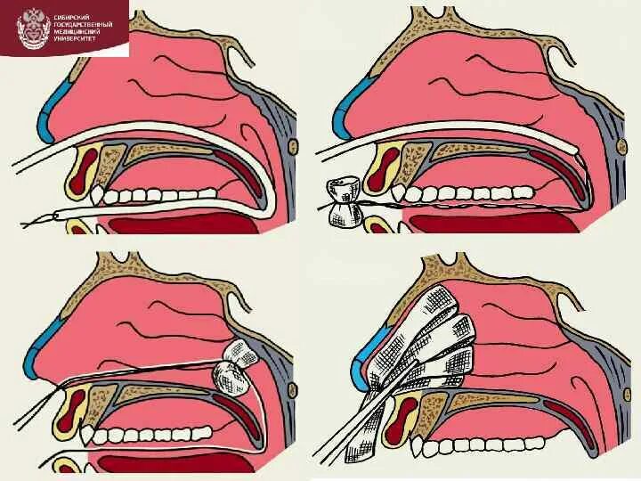 Носовое кровотечение задняя тампонада носа. Задняя тампонада носовой полости. Носовое кровотечение передняя тампонада. Передняя тампонада полости носа.