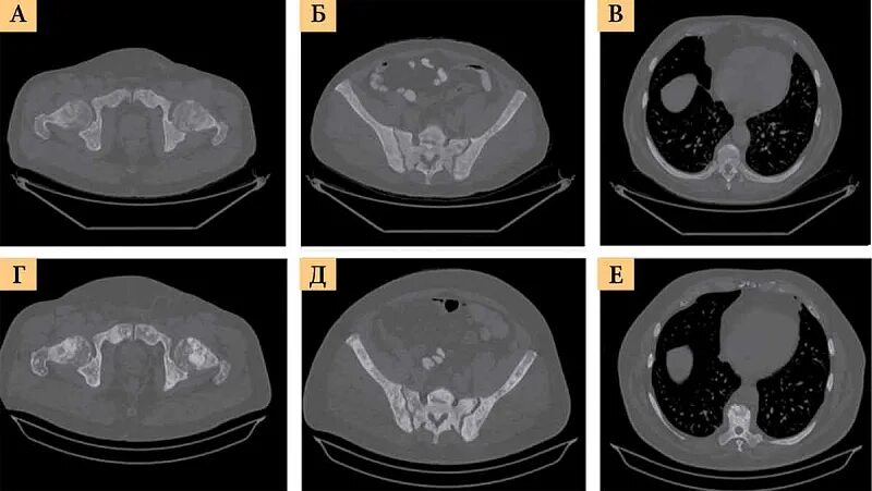 Метастазы в кости при раке предстательной