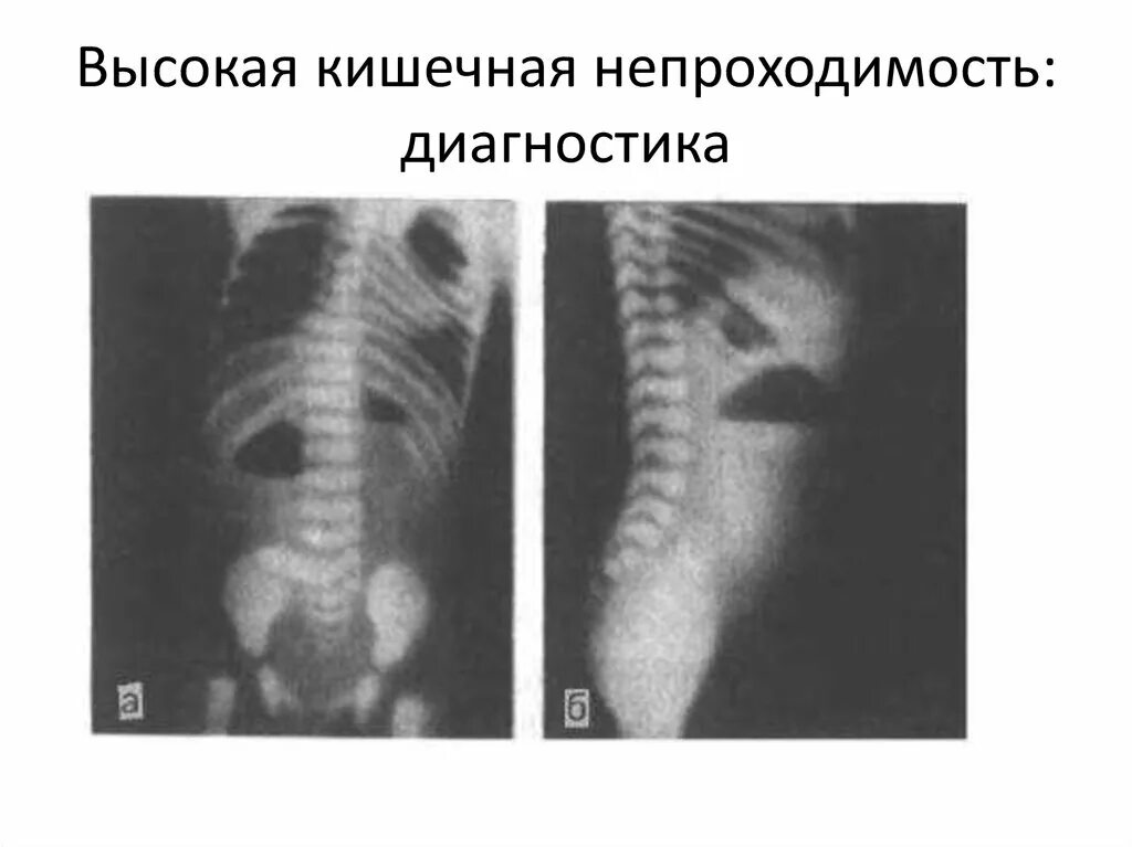 Кишечная непроходимость это. Врожденная высокая кишечная непроходимость рентген. тонкокишечная непроходимость рентген. высокая кишечная непроходимость рентген. высокая и низкая врожденная кишечная непроходимость рентген.