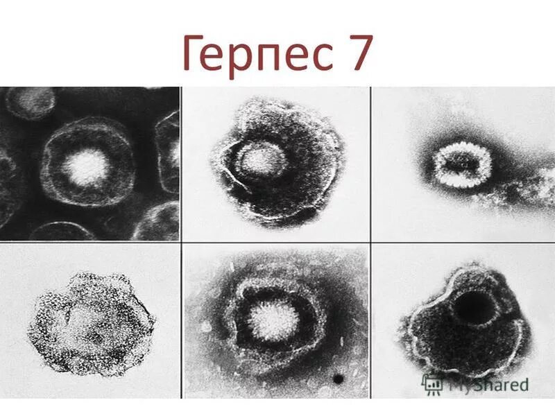 Герпесвирусы 6 и 7 типа.