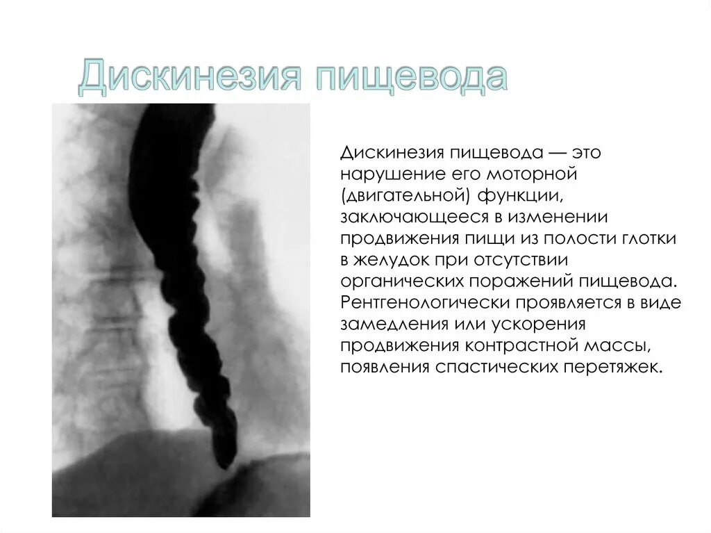 С г пищевода. Дискинезия пищевода рентген. Гипомоторная дискинезия пищевода рентген. Нарушение перистальтики пищевода. Спастические сокращения пищевода.