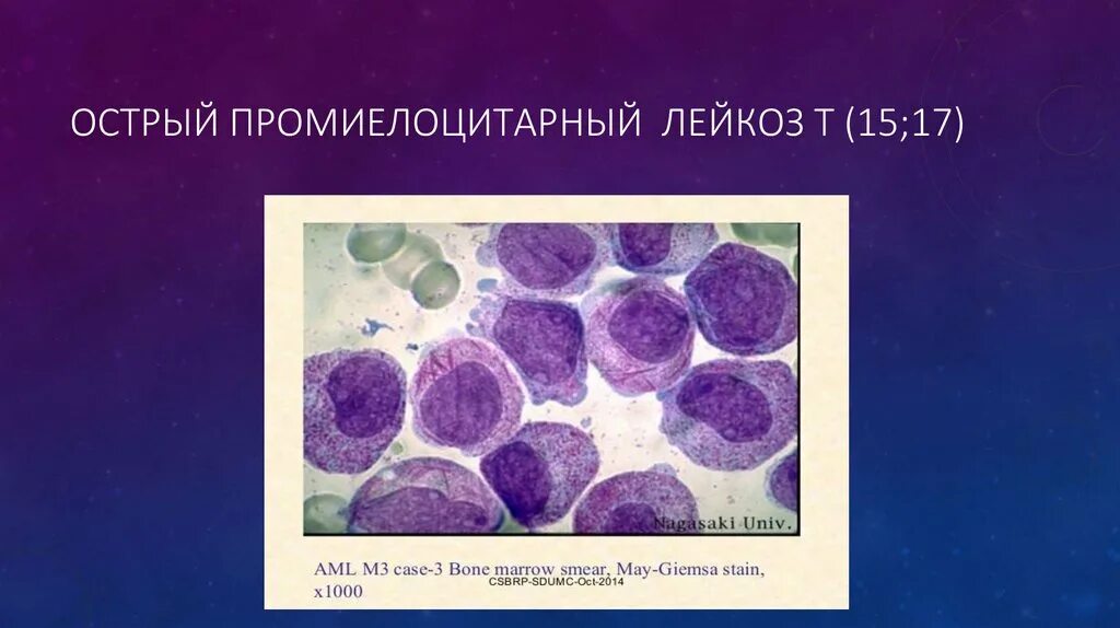 Острый лимфобластный лейкоз гистология. Острый миелобластный лейкоз гистология. Лимфобластный лейкоз гистология. Хронический миелолейкоз гистология.