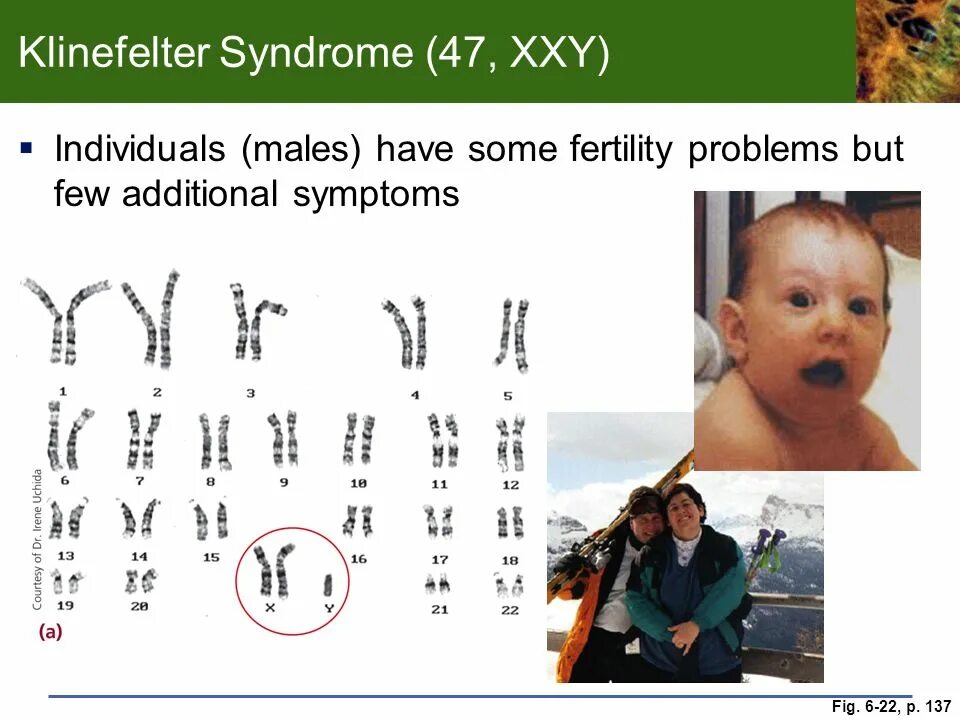 Синдром Клайнфельтера 47 xxy. Клайнфельтер хромосомы. Xxy синдром Клайнфельтера.