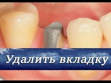 Вкладка 1 зуб