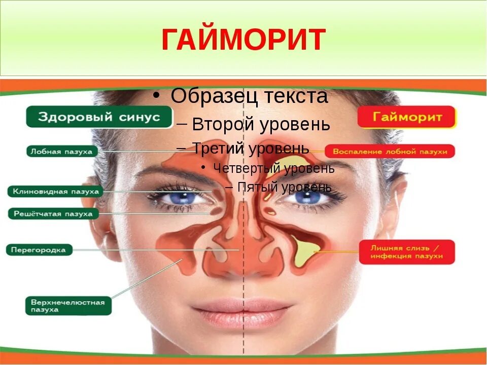 Синусит гайморит фронтит. Симптомы гайморита у взрослых без температуры признаки