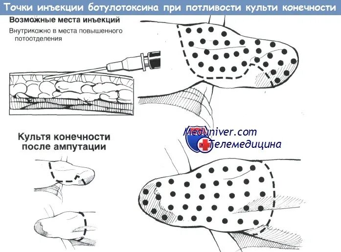 Схема ампутации конечности. Точка уколова