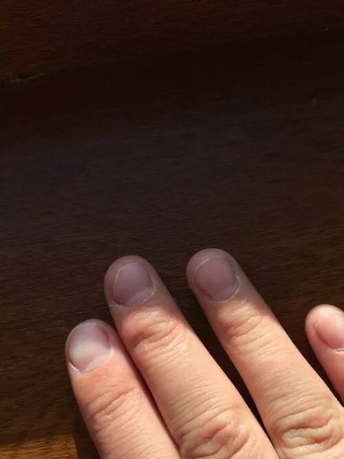 Наращивание пальца. Коричневое пятно под ногтем на руке. Дрожжевой грибок на ногтях.