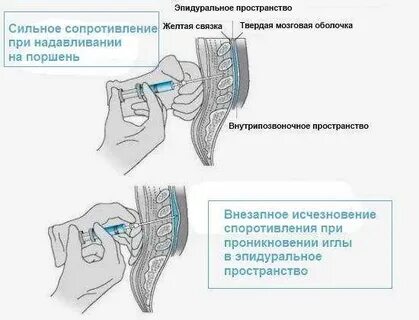 Общий наркоз при грыже