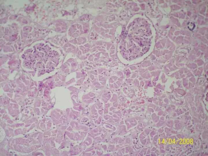 Некротический нефроз гистология. Некротический нефроз патанатомия. Некротический некрозмикропрепарат. Канальцевый некроз гистология. Пиелонефрит микропрепарат