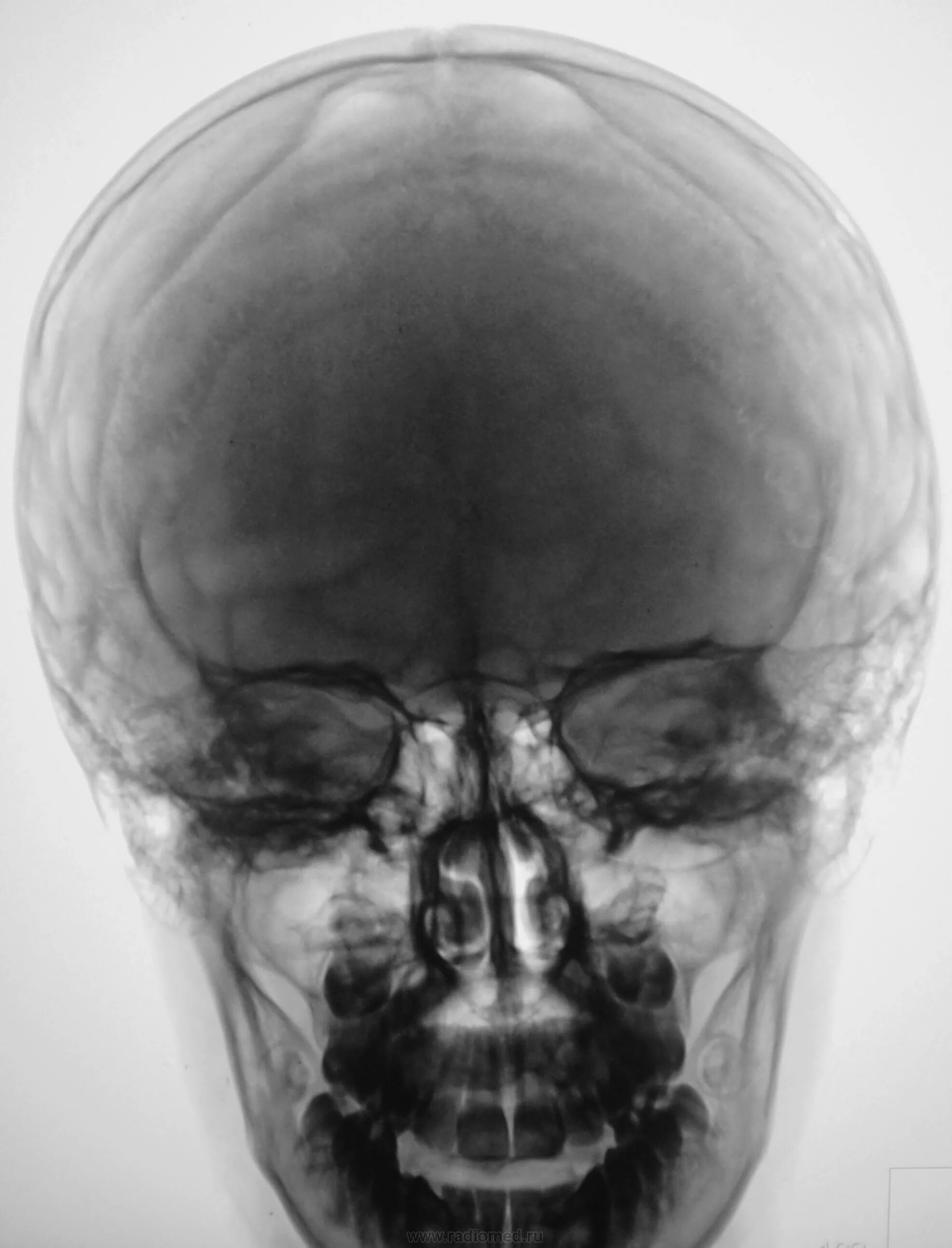 Патология костей черепа рентген. Рентген снимок черепа норма. Рентгенограмма черепа норма.