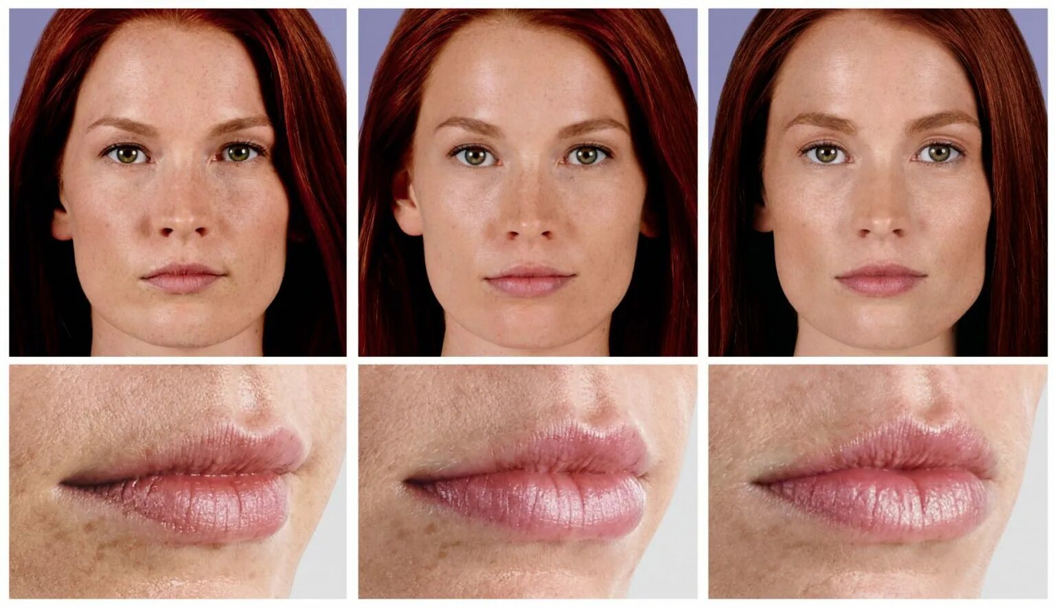 Биоревитализация губ до и после. Juvederm ультра 3. Ювидерм 3 Ювидерм ультра Смайл. Juvederm Ultra smile 0.55.