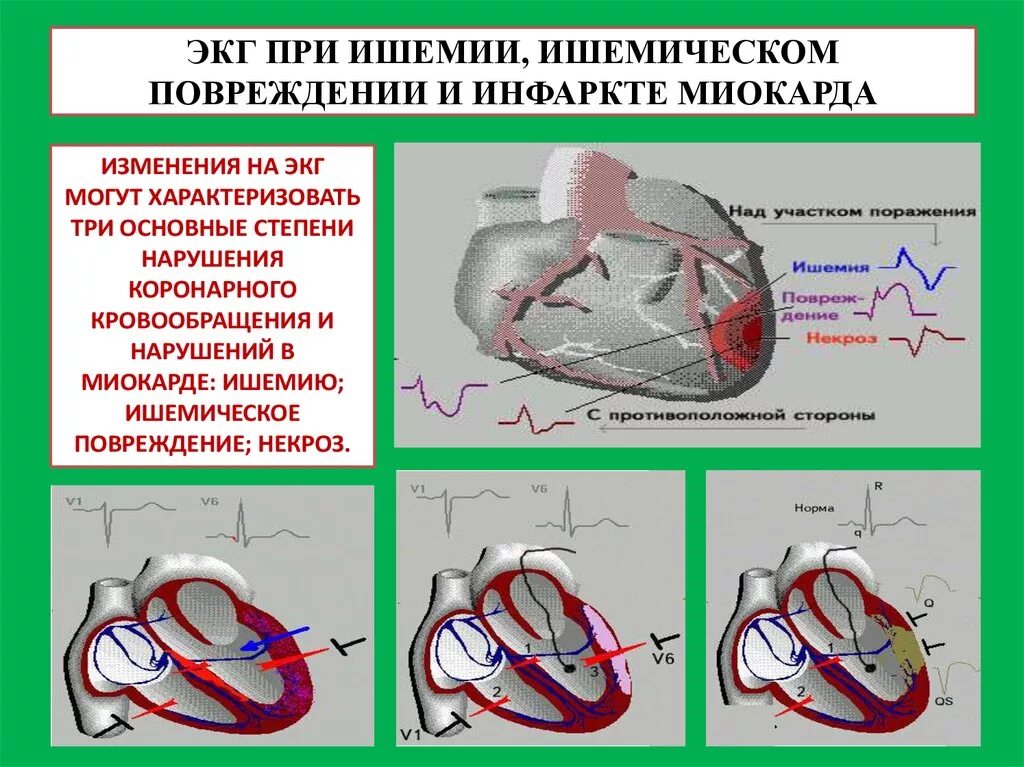 Критерии ишемии. ЭКГ критерии ишемии и повреждения миокарда. ЭКГ при ишемических изменениях миокарда. ЭКГ критерии ишемии и повреждение. ЭКГ критерии повреждения миокарда.