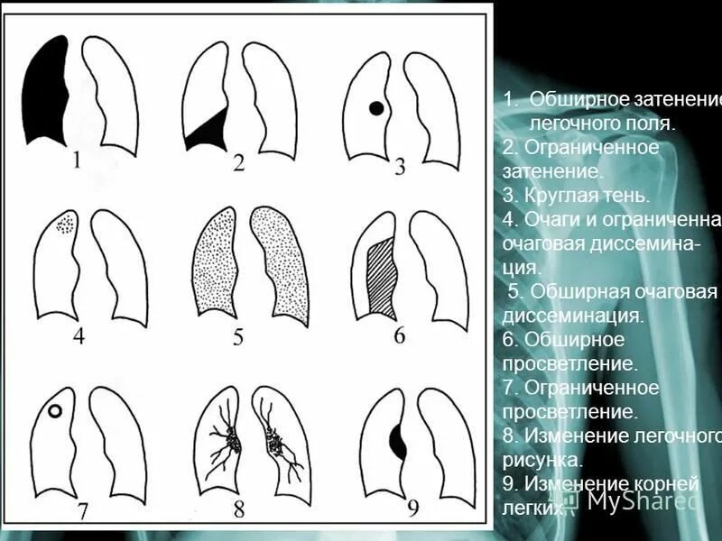 Верхние доли легких тени. Основные рентгенологические синдромы туберкулеза. Синдром очаговой диссеминации рентген. Синдром затемнения легочного поля рентген. Синдром обширного просветления легочного поля схема.