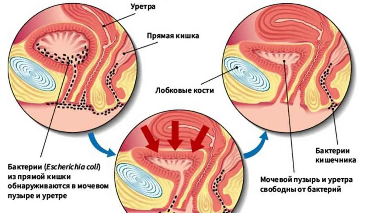 Цистит от чего он. Цистит воспаление мочевого пузыря. цистит у женщин.