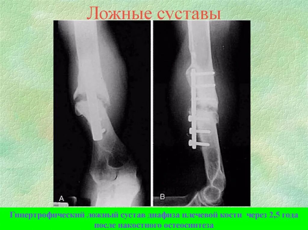 Костная мозоль после перелома плечевой кости на рентгене. Ложный сустав плечевой кости на кт. Ложный сустав после перелома плечевой кости рентген. Ложный сустав бедренной кости рентген.