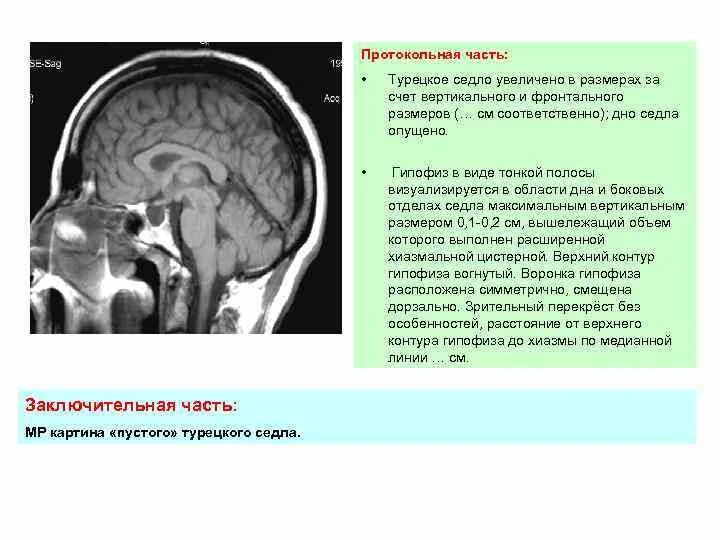 Формирующееся пустое турецкое седло головного. Пустое турецкое седло мрт заключение. Пустое турецкое седло на кт. Турецкое седло на кт. Турецкое седло расширено.