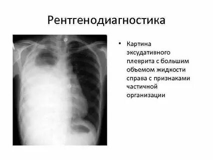 Тест плевриты