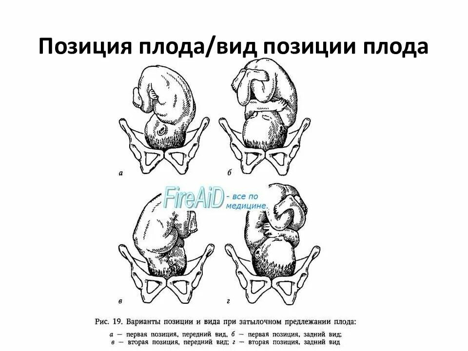 Самопроизвольное предлежание. Передний и задний вид затылочного предлежания. Затылочное предлежание передний вид 2 позиция. Затылочное предлежание 2 позиция задний вид. 1 Позиция передний вид затылочного предлежания.