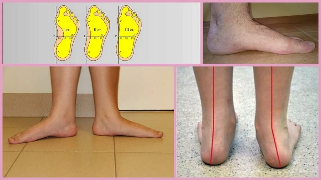 Плоскостопие на одной ноге берут ли. Двустороннее продольное плоскостопие 2ст. Ортопед продольное плоскостопие. Плоскостопие 2-3 степени вальгус. Продольное плоскостопие 2 степени.
