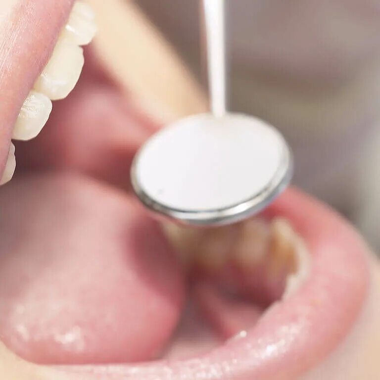 Зубной. Заболевания полости рта. Кариес зуба осмотр полости рта. Восстановление ротовой полости. Восстановление ротовой полости.