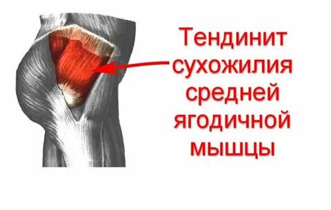 Тендиноз тазобедренного сустава лечение у женщин