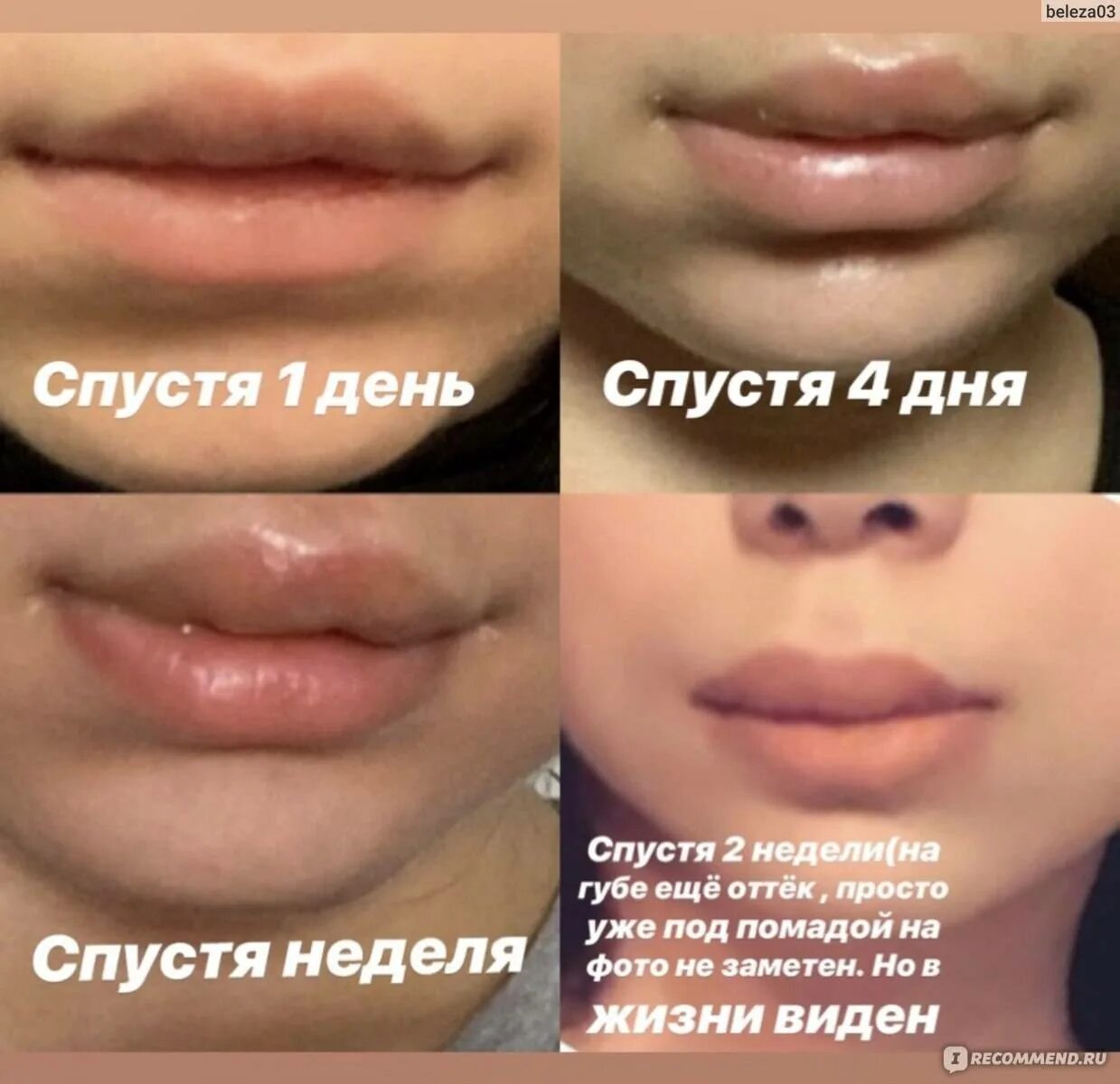 Можно ли мазать губы гиалуроновой кислотой. Накачивание губ гиалуроновой кислотой 1 мл. губы гиалуроновой кислотой зажившие 1мл. коррекция губ гиалуроновой кислотой.