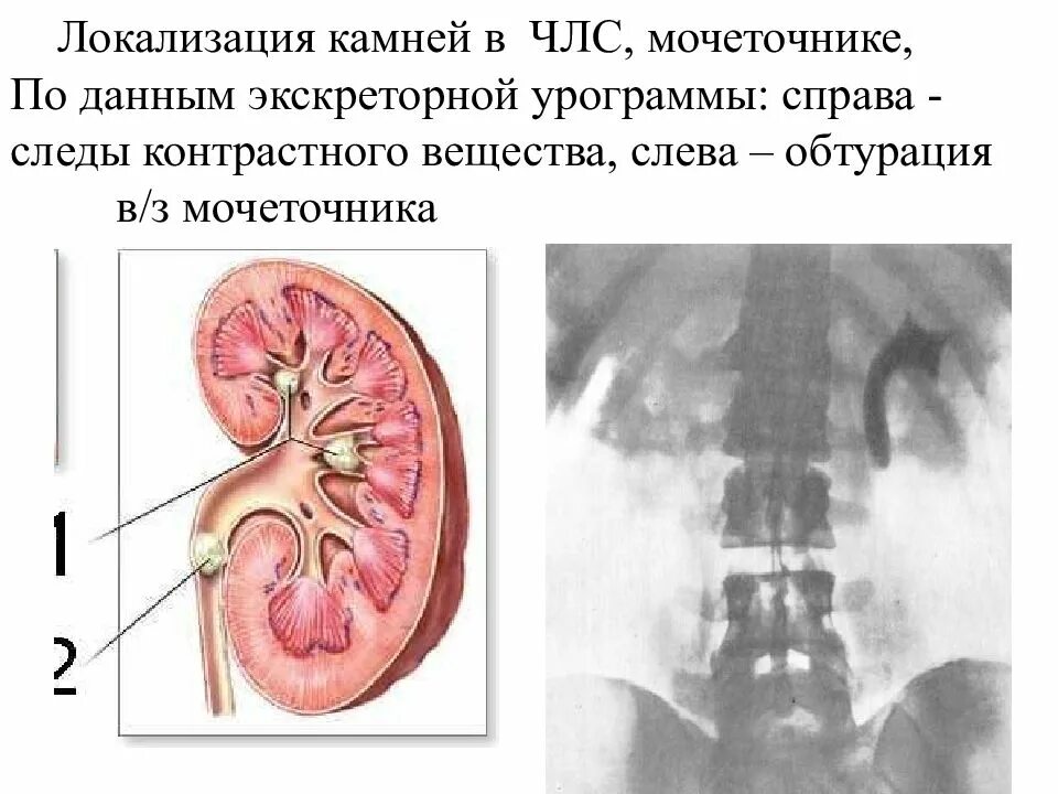 Члс расширена. Камень в чашечно лоханочной системе. Конкремент мочеточника. Локализация камней в мочеточнике.