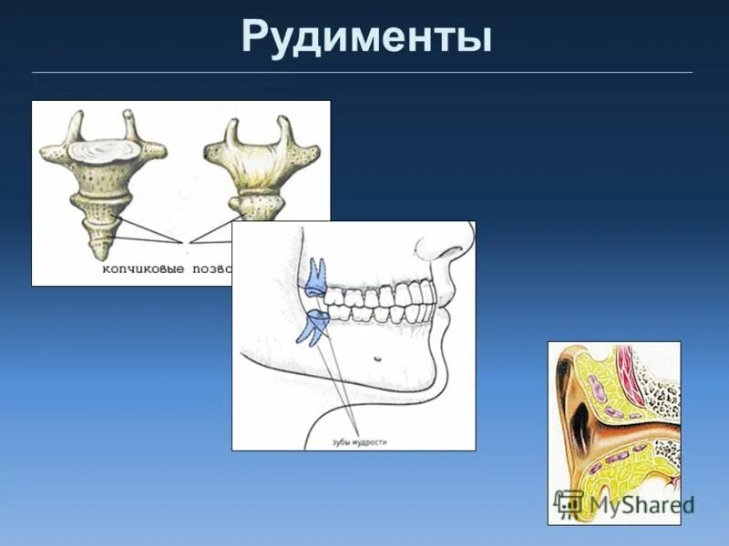 Режется зуб мудрости и болит 6 и 7 зубы. Рудименты человека зубы мудрости. Зубы мудрости рудимент. Боль от зуба мудрости отдает в другие. Зубы мудрости как рудимент.