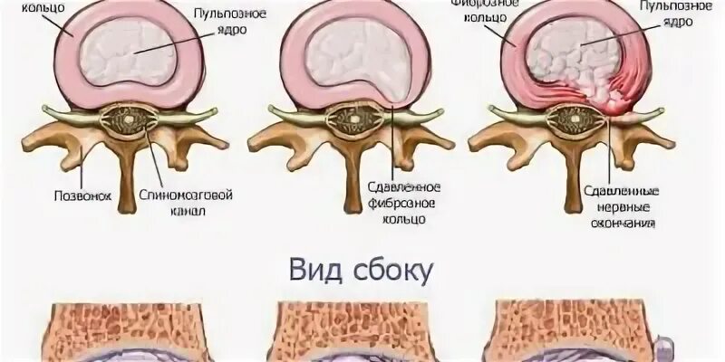 Операция протрузии дисков позвоночника