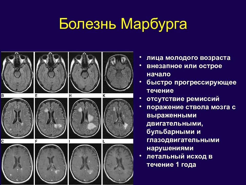 Демиелинизация головного. Марбурга демиелинизация. Рассеянный склероз Марбурга. Демиелинизирующие заболевания головного мозга на мрт. Болезнь Марбурга.