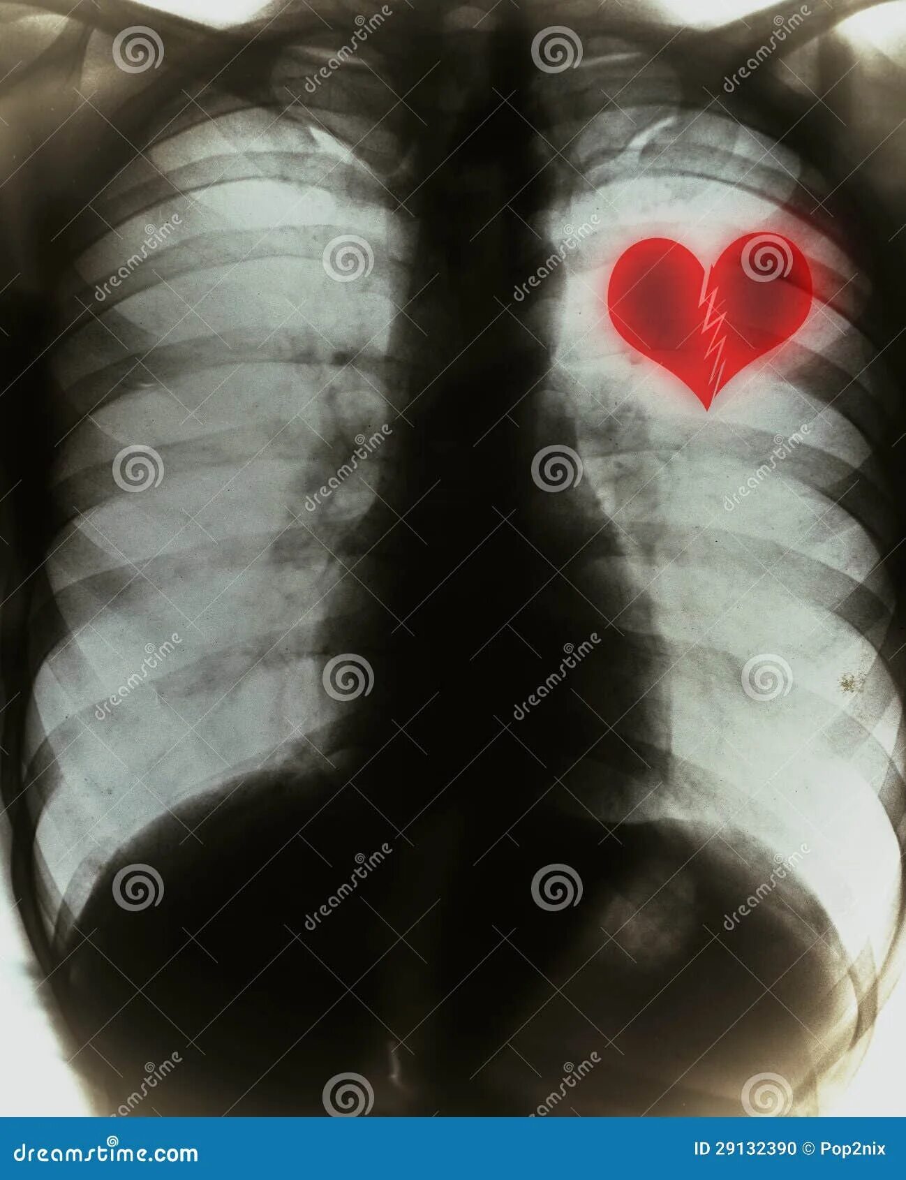 Рентгенограмма органов грудной полости - норма - 24Radiology.ru