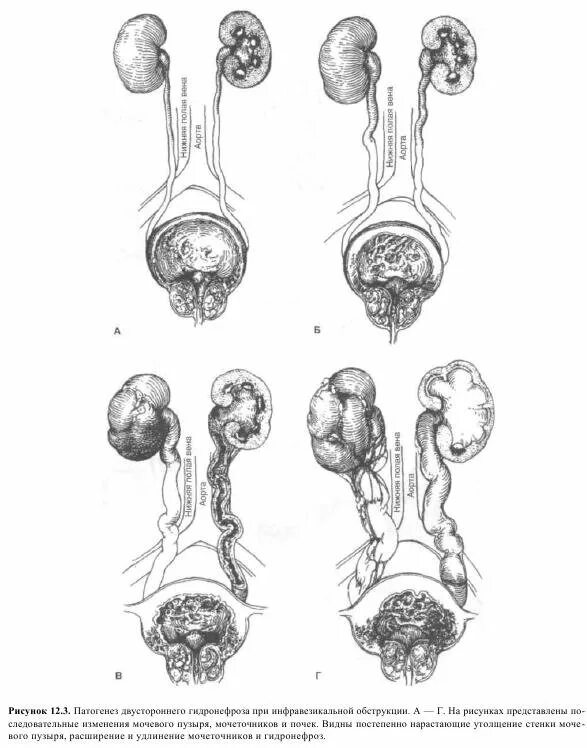 Обструкция мочеточника. Обструкция нижних мочевых путей. Нейромышечная дисплазия мочеточника. Эктопия устья мочеточника шеечная. Гидронефроз мочевого пузыря.