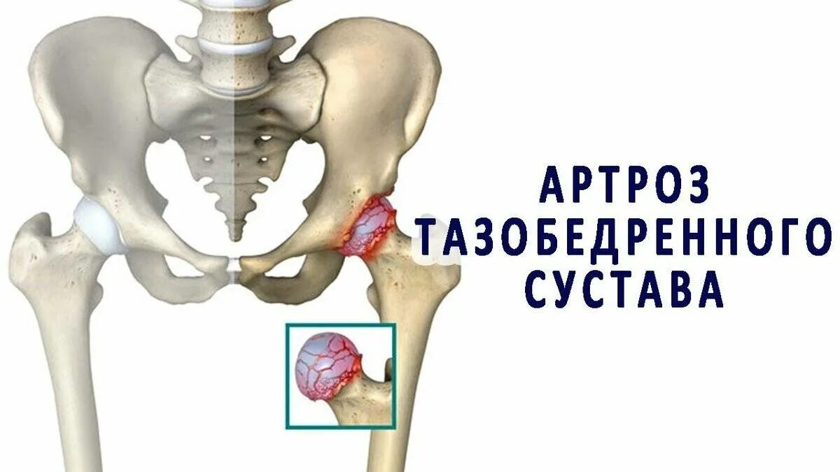 Артроз операция тазобедренного сустава. Коксартроз (артроз тазобедренного сустава). Артроза тазобедренного сустава коксартроза. Мазь для тазобедренного сустава. Коксартроз тазобедренного сустава мази.