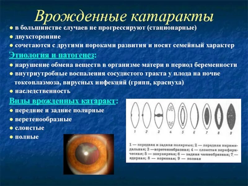 Капсулярная врожденная катаракта. Врожденные катаракты этиология.