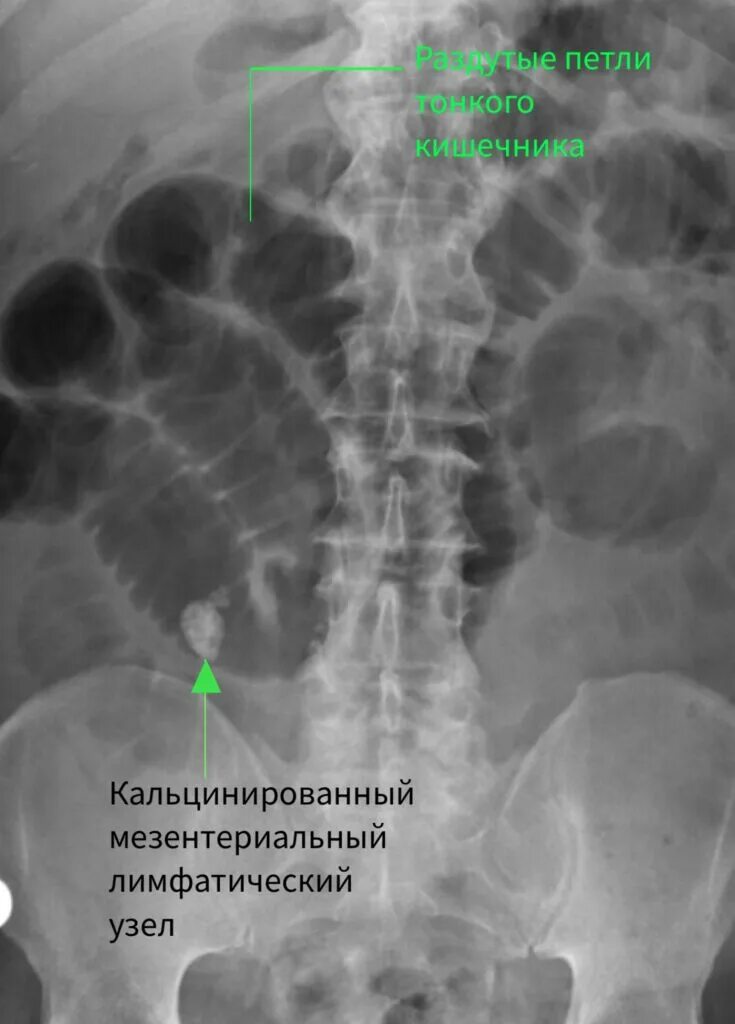 Лимфатические узлы в кишечнике. Туберкулез мезентериальных лимфоузлов. Абдоминальный туберкулез рентген. Туберкулез брыжеечных лимфатических узлов. Мезентериальные лимфатические узлы туберкулёз.