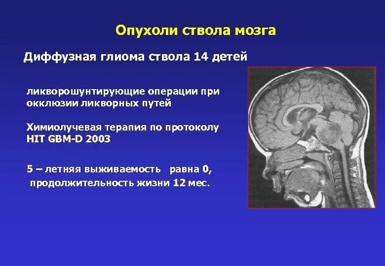 Глиома у детей. Характерный симптом опухоли ствола мозга:. Объемное образование ствола головного мозга. Диффузная глиома ствола мозга.