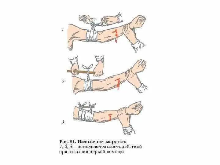 Признаки неправильного наложения жгута. Оказание первой помощи при артериальном и венозном кровотечении. Артериальное кровотечение схема. Схема оказания первой помощи при кровотечениях. Этапы оказания первой помощи при наружных кровотечениях.