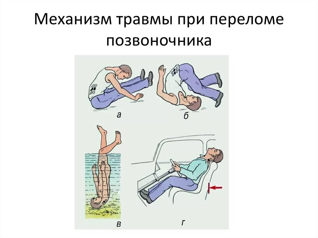 Д3 при переломах. Сгибательный механизм травмы позвоночника. Повреждение позвоночника механизм повреждения. Сгибательный механизм перелома позвоночника. Механизмы травмы при переломах позвоночника.