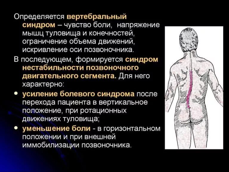 Синдром скользящего. Мышечно-тонический синдром. вертебральный болевой синдром. мышечно-тонический болевой синдром. остеохондроз мышечно тонический.