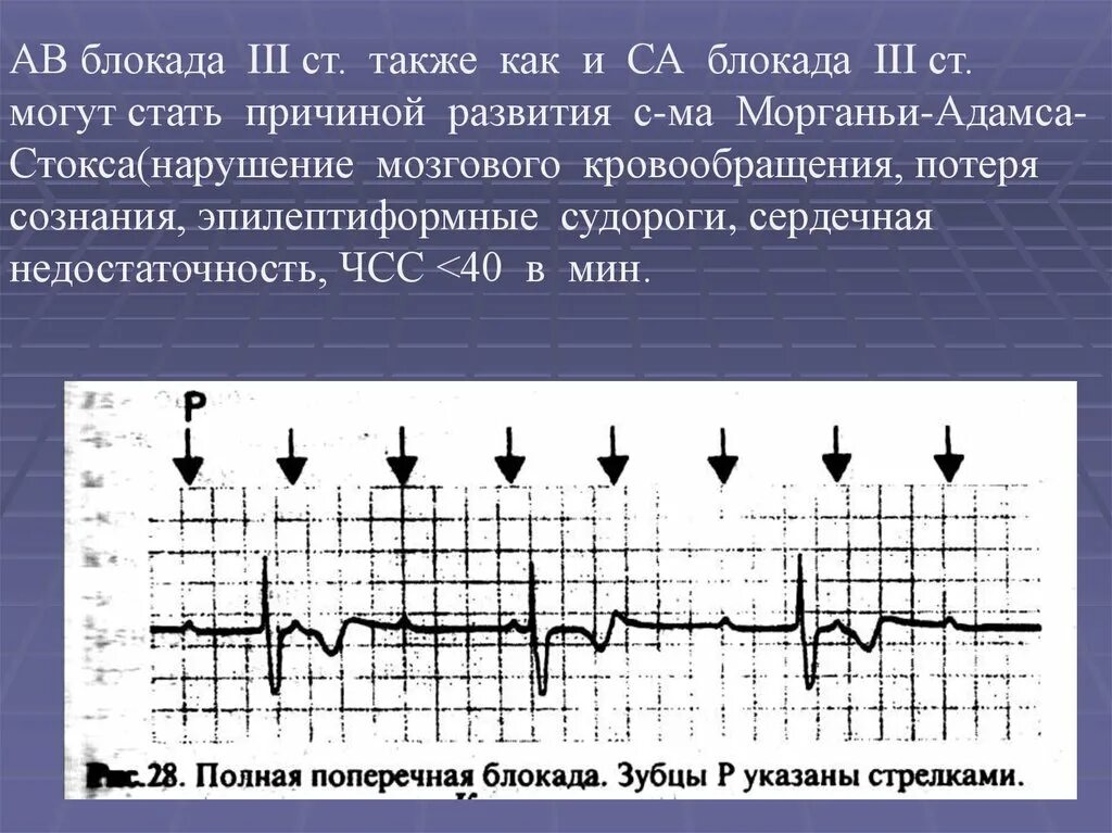 Блокада заболевание. ЧСС при АВ блокаде 3 степени. АВ блокада 3ст с МЭС. АВ блокада 3 ст на ЭКГ. Атриовентрикулярная блокада это аритмия.