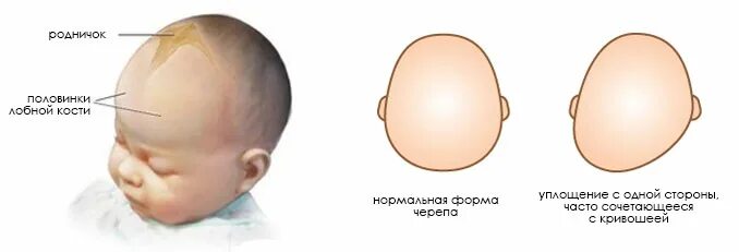 Родничок 2 месяца. Форма головы сбоку младенца. Форма головы у грудничка 4 месяца норма. Форма головы у 2 месячного ребенка норма.