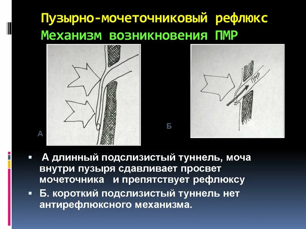 Рефлюкс мочеточника. Пузырно-мочеточниковый рефлюкс механизм. Операция пузырно мочеточниковом рефлюксе. Механизм пузырно мочеточникового рефлюкса. Антирефлюксная операция на мочеточниках.