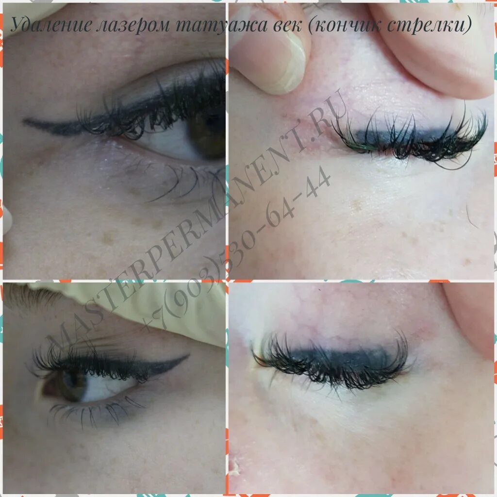 удаление татуажа век отзывы