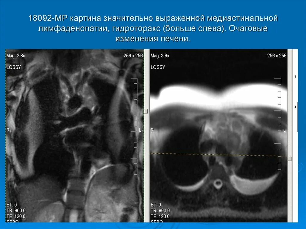 Лимфаденопатия средостения легких. Медиастинальная лимфаденопатия кт. Средостенная лимфаденопатия. Медиастинальная аксиллярная лимфаденопатия. Количественная медиастинальная лимфаденопатия.